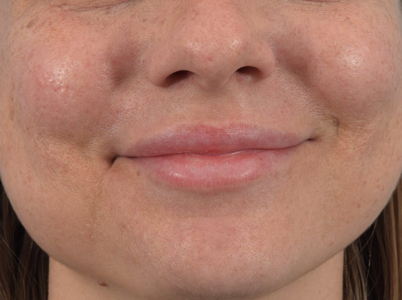 Filler - Lips Before & After Gallery - Patient 36543183 - Image 2