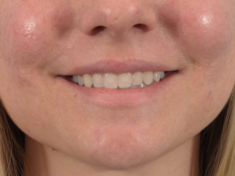 Filler - Lips Before & After Gallery - Patient 36543183 - Image 3