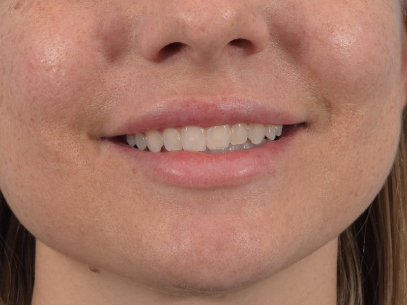 Filler - Lips Before & After Gallery - Patient 36543183 - Image 4