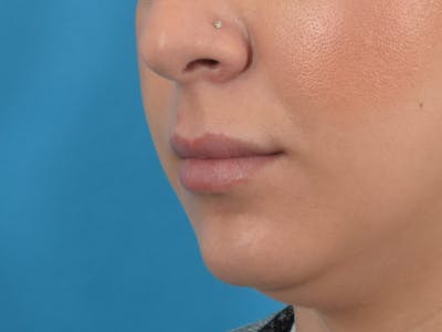 Filler - Lips Before & After Gallery - Patient 36543185 - Image 1