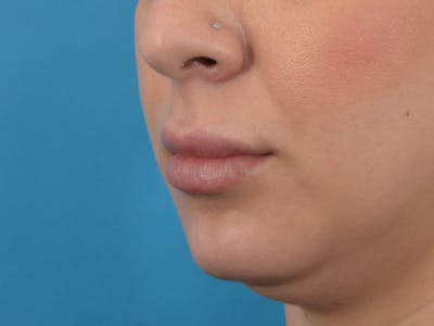 Filler - Lips Before & After Gallery - Patient 36543185 - Image 2