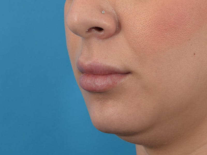 Filler - Lips Before & After Gallery - Patient 36543185 - Image 2
