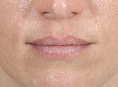 Filler - Lips Before & After Gallery - Patient 36543186 - Image 1