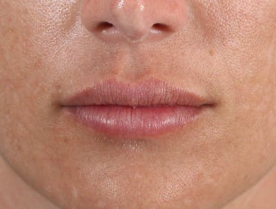 Filler - Lips Before & After Gallery - Patient 36543186 - Image 2