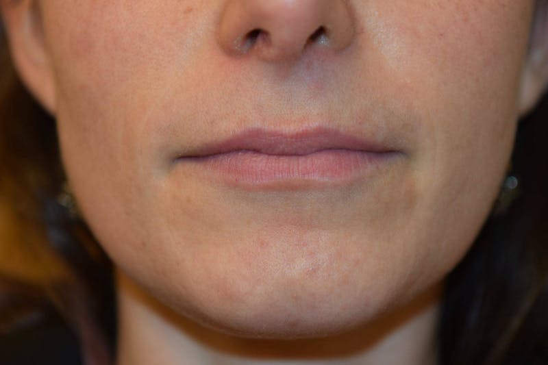 Filler - Lips Before & After Gallery - Patient 36543187 - Image 1