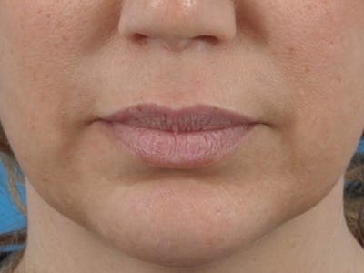 Filler - Lips Before & After Gallery - Patient 36543188 - Image 1