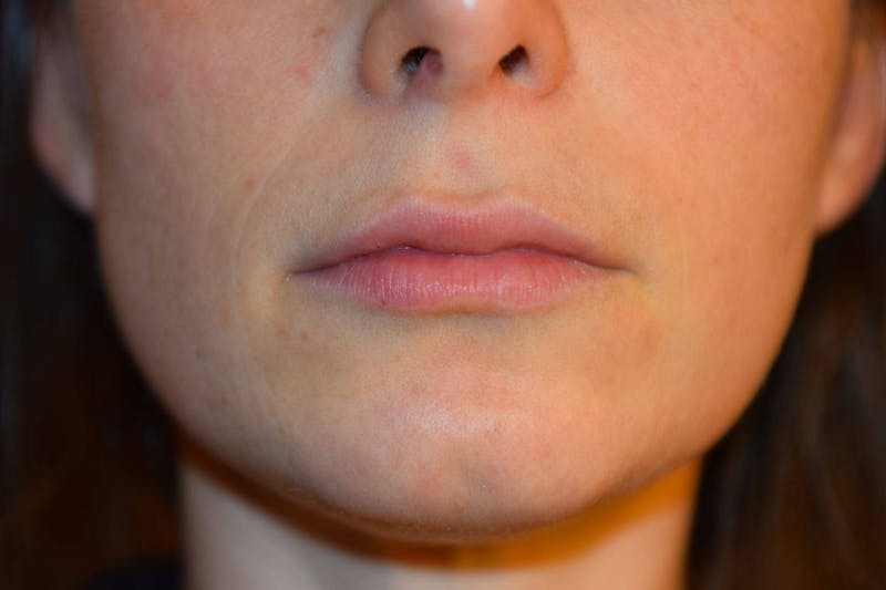 Filler - Lips Before & After Gallery - Patient 36543187 - Image 2