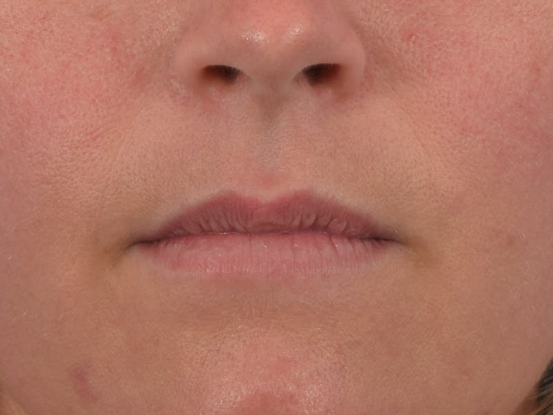 Filler - Lips Before & After Gallery - Patient 36543189 - Image 1