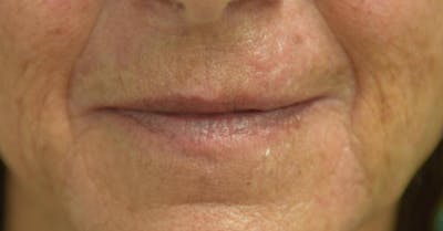Filler - Lips Before & After Gallery - Patient 36543190 - Image 1
