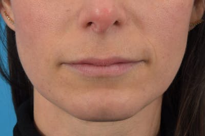 Filler - Lips Before & After Gallery - Patient 36543191 - Image 1