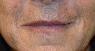 Filler - Lips Before & After Gallery - Patient 36543190 - Image 2