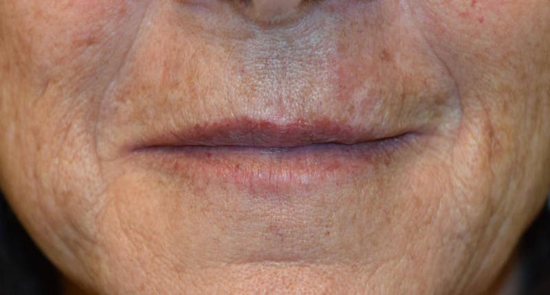 Filler - Lips Before & After Gallery - Patient 36543190 - Image 2