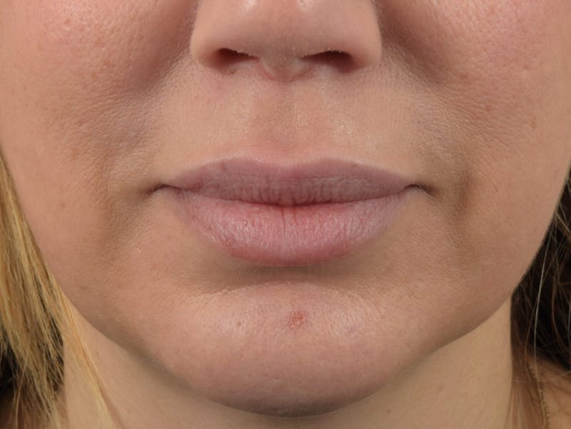 Filler - Lips Before & After Gallery - Patient 36543188 - Image 2