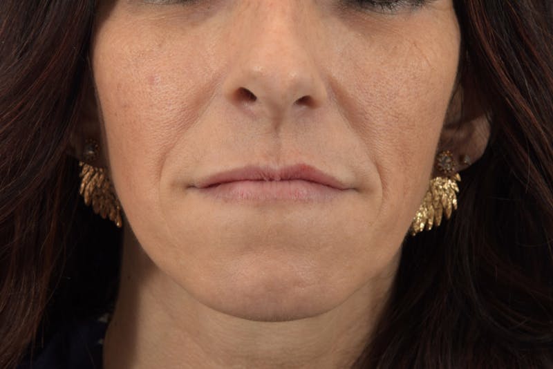 Filler - Lips Before & After Gallery - Patient 36543192 - Image 1