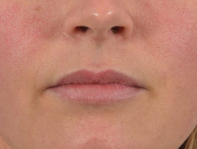 Filler - Lips Before & After Gallery - Patient 36543189 - Image 2