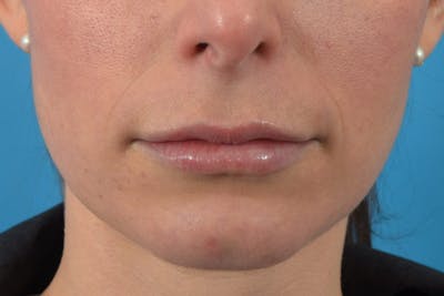 Filler - Lips Before & After Gallery - Patient 36543191 - Image 2