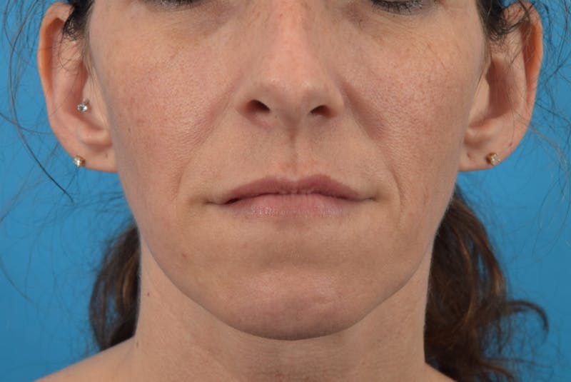 Filler - Lips Before & After Gallery - Patient 36543192 - Image 2