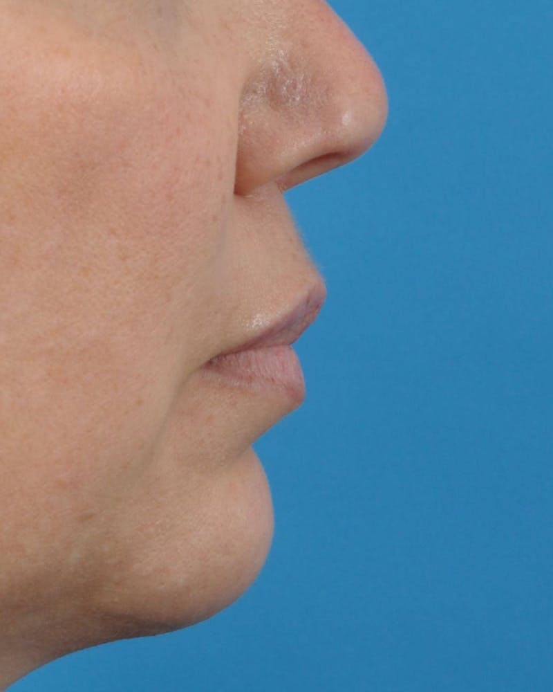 Filler - Lips Before & After Gallery - Patient 36543188 - Image 3