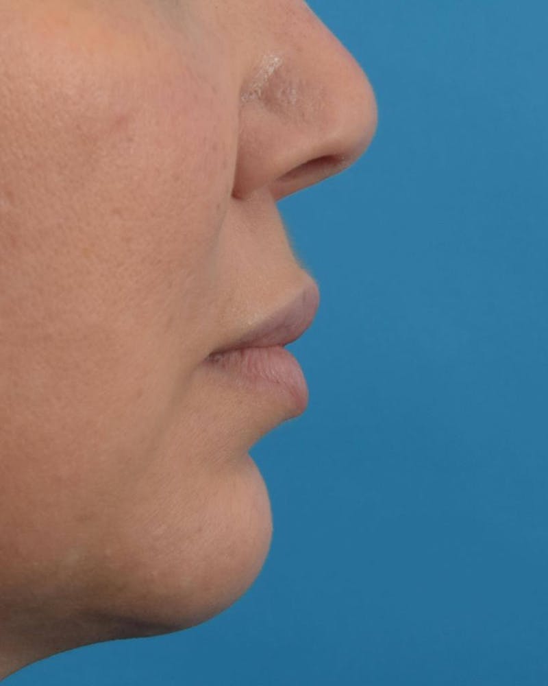 Filler - Lips Before & After Gallery - Patient 36543188 - Image 4