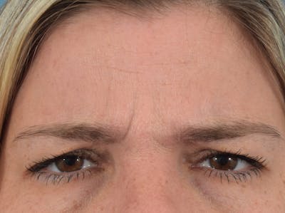 Neuromodulators (Botox, Dysport...) Before & After Gallery - Patient 36543200 - Image 1