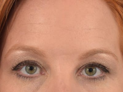 Neuromodulators (Botox, Dysport...) Before & After Gallery - Patient 36543201 - Image 1
