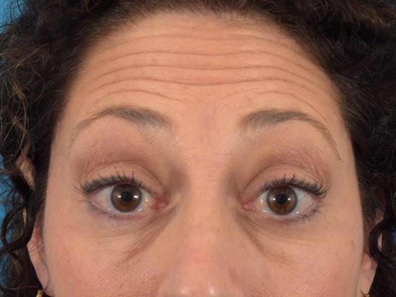 Neuromodulators (Botox, Dysport...) Before & After Gallery - Patient 36543202 - Image 1