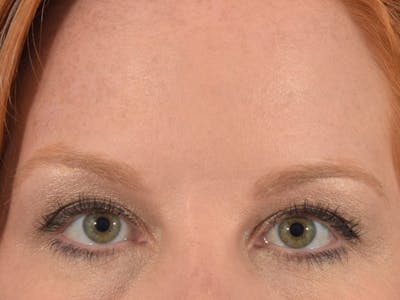 Neuromodulators (Botox, Dysport...) Before & After Gallery - Patient 36543201 - Image 2