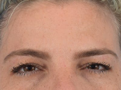 Neuromodulators (Botox, Dysport...) Before & After Gallery - Patient 36543200 - Image 2