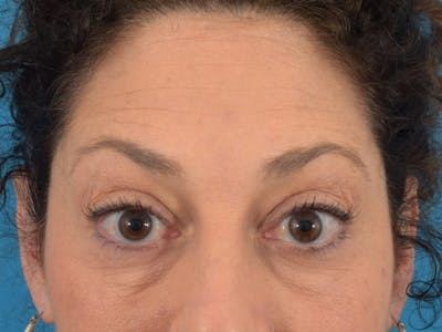 Neuromodulators (Botox, Dysport...) Before & After Gallery - Patient 36543202 - Image 2