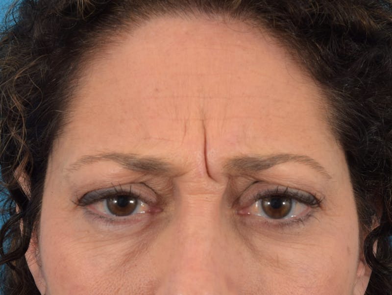 Neuromodulators (Botox, Dysport...) Before & After Gallery - Patient 36543202 - Image 3