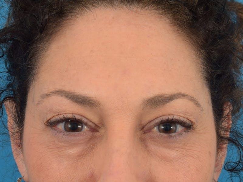 Neuromodulators (Botox, Dysport...) Before & After Gallery - Patient 36543202 - Image 4