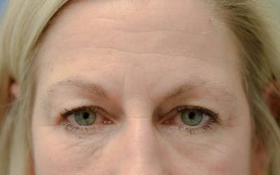 Neuromodulators (Botox, Dysport...) Before & After Gallery - Patient 36543203 - Image 1