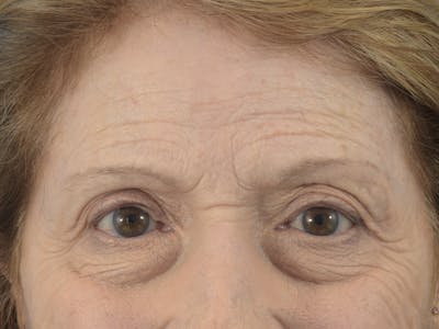 Neuromodulators (Botox, Dysport...) Before & After Gallery - Patient 36543204 - Image 1