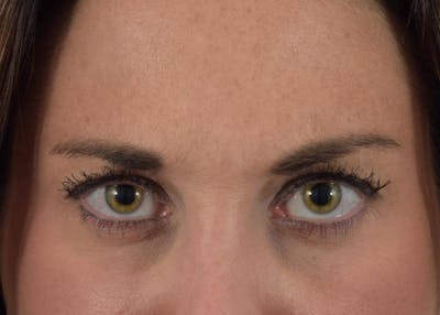 Neuromodulators (Botox, Dysport...) Before & After Gallery - Patient 36543205 - Image 2