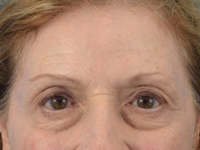 Neuromodulators (Botox, Dysport...) Before & After Gallery - Patient 36543204 - Image 2