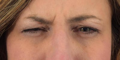 Neuromodulators (Botox, Dysport...) Before & After Gallery - Patient 36543206 - Image 1