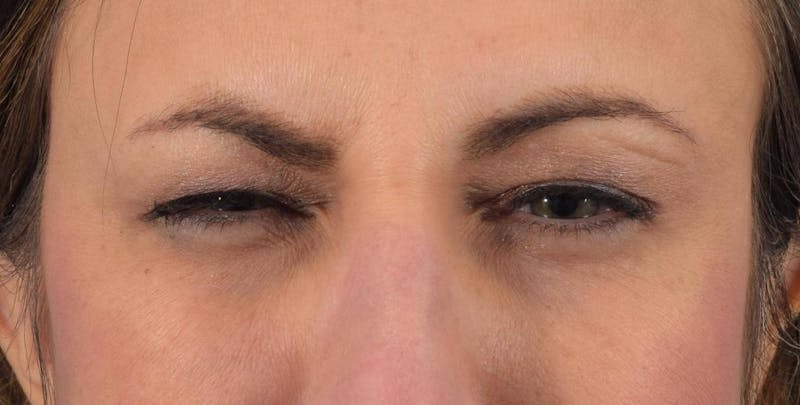 Neuromodulators (Botox, Dysport...) Before & After Gallery - Patient 36543206 - Image 2