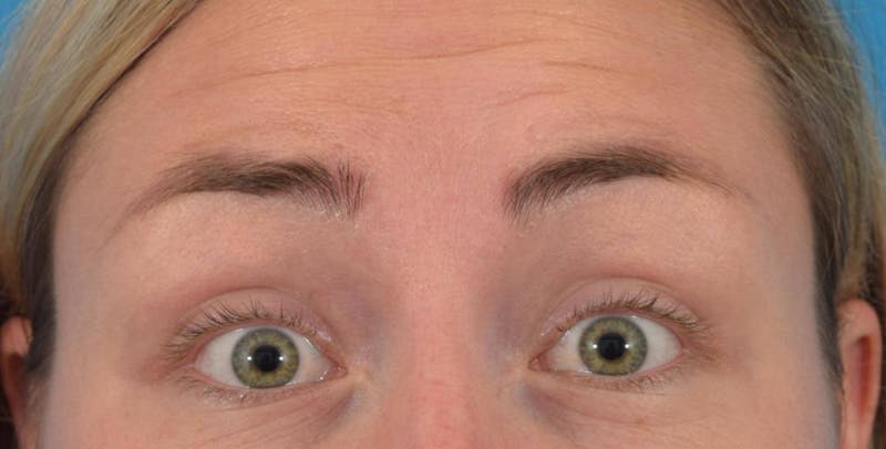 Neuromodulators (Botox, Dysport...) Before & After Gallery - Patient 36543207 - Image 1