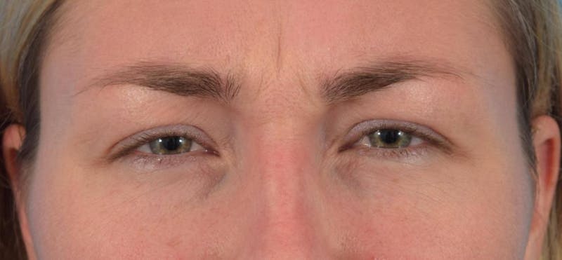 Neuromodulators (Botox, Dysport...) Before & After Gallery - Patient 36543207 - Image 3