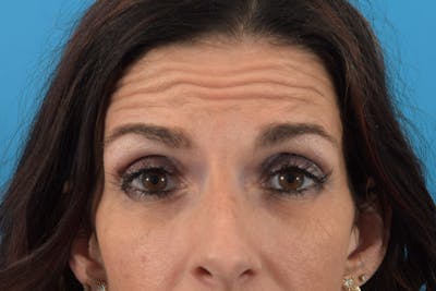 Neuromodulators (Botox, Dysport...) Before & After Gallery - Patient 36543214 - Image 1