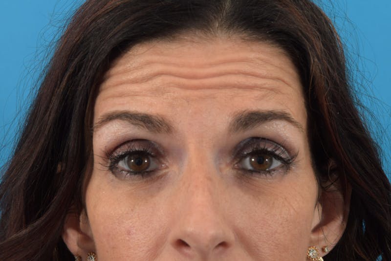 Neuromodulators (Botox, Dysport...) Before & After Gallery - Patient 36543214 - Image 1