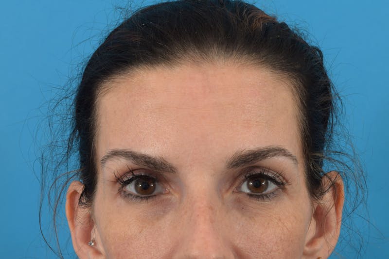 Neuromodulators (Botox, Dysport...) Before & After Gallery - Patient 36543214 - Image 2