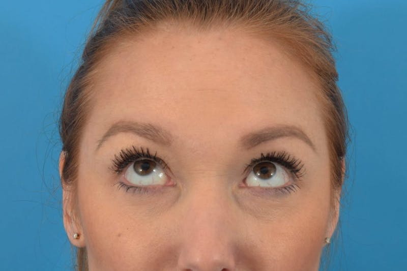 Neuromodulators (Botox, Dysport...) Before & After Gallery - Patient 36543215 - Image 2