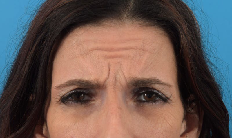 Neuromodulators (Botox, Dysport...) Before & After Gallery - Patient 36543214 - Image 3
