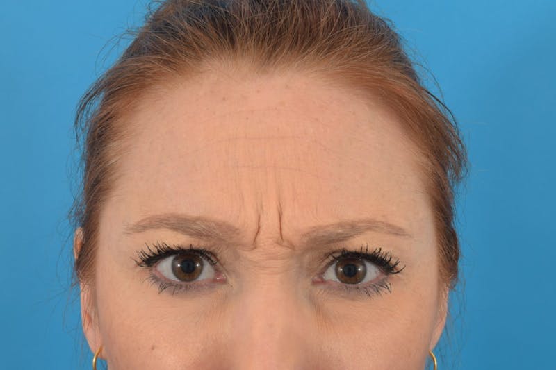 Neuromodulators (Botox, Dysport...) Before & After Gallery - Patient 36543215 - Image 3
