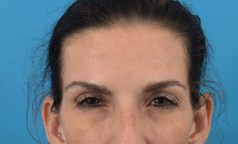 Neuromodulators (Botox, Dysport...) Before & After Gallery - Patient 36543214 - Image 4