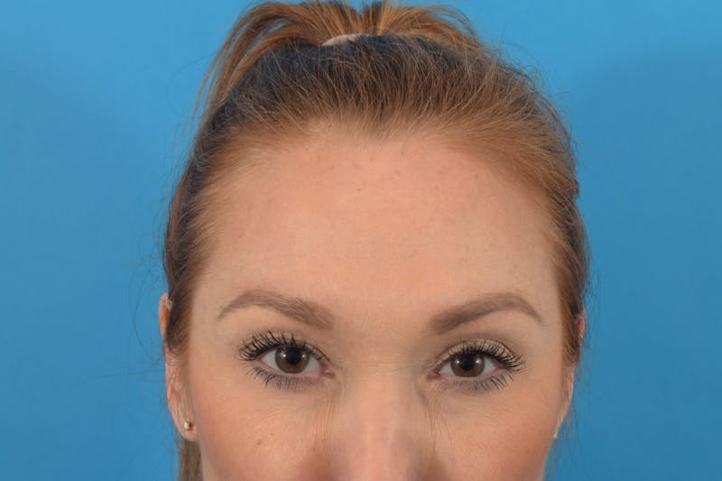Neuromodulators (Botox, Dysport...) Before & After Gallery - Patient 36543215 - Image 4