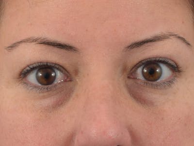 Filler-Tear Trough Before & After Gallery - Patient 36543216 - Image 1