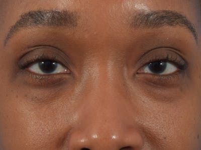 Filler-Tear Trough Before & After Gallery - Patient 36543217 - Image 1