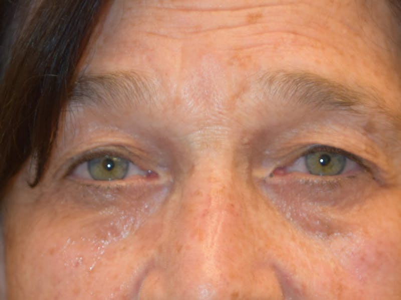 Filler-Tear Trough Before & After Gallery - Patient 36543218 - Image 1